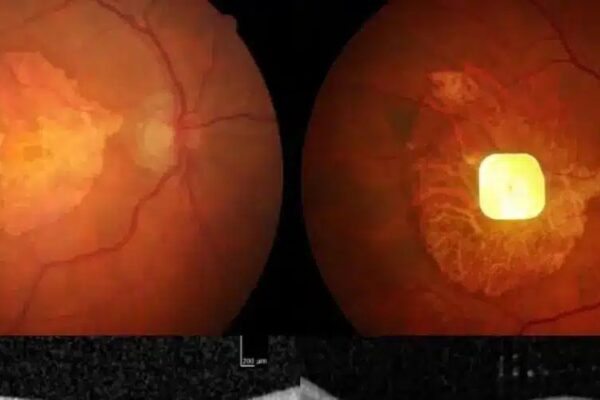 Имплантат и умные очки вернули зрение людям с возрастной слепотой